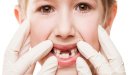 تعرف على علاج الأسنان المتآكلة عند الأطفال