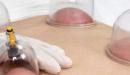 علاج سرعة القذف بالحجامة