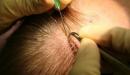 طريقة زرع الشعر