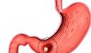 اعراض العصب في المعدة