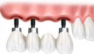 كيف تتم عملية زراعة الأسنان؟