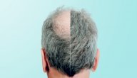 هل يجوز زراعة الشعر