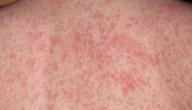 ما علاج الطفح الجلدي