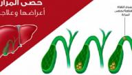 أسباب تكون الحصى في المرارة