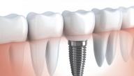 ما هي أضرار زراعة الأسنان؟