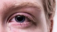 اسباب حرقة العين والدموع