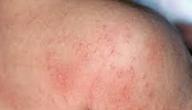 ظهور طفح جلدي مفاجئ