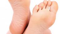علاج سريع لتشقق القدمين