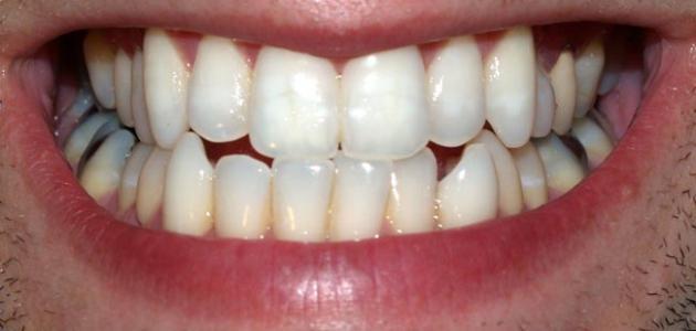 أبرز المعلومات عن تسوس الأسنان