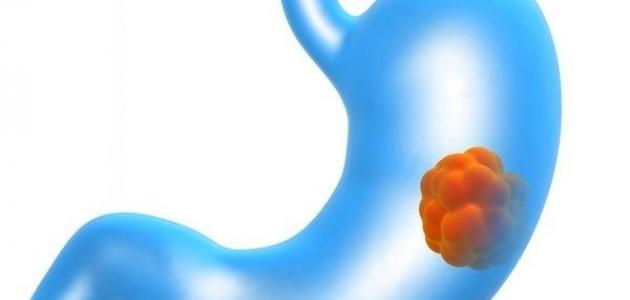 معلومات عن مرض سرطان المعدة