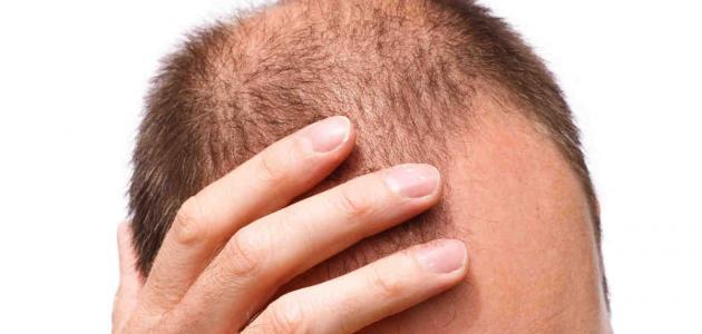هل زراعة الشعر لها اضرار