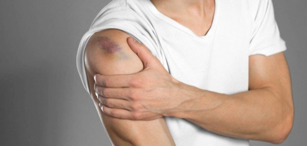 اسباب ظهور الكدمات بدون سبب