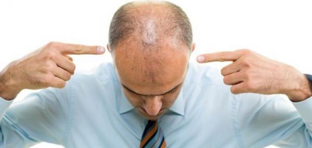 علاج تساقط شعر مقدمة الراس