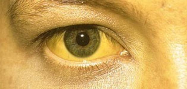 أسباب اصفرار الوجه المفاجئ