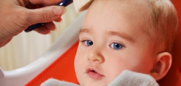 علاج قشرة الراس عند الاطفال