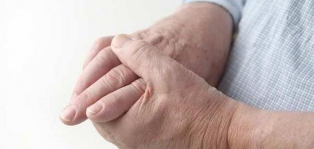 أفضل علاج للنقرس