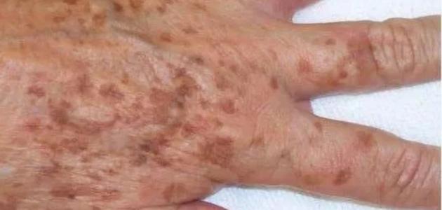 ظهور بقع بنية على اليد