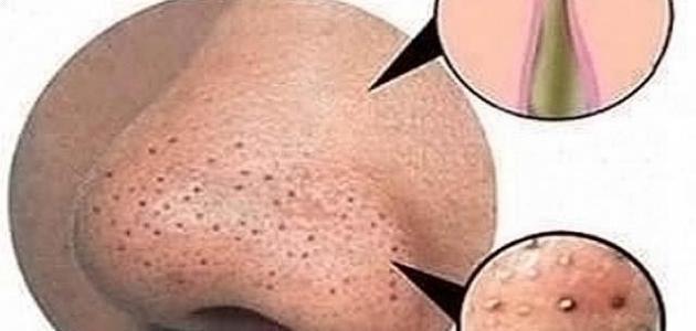 ظهور بقع سوداء في الوجه