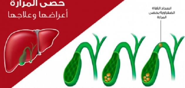 أسباب تكون الحصى في المرارة