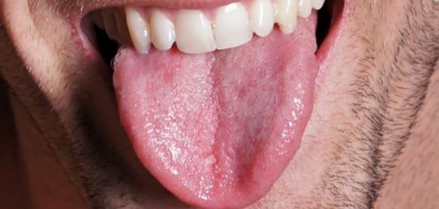 علاج تنميل اللسان
