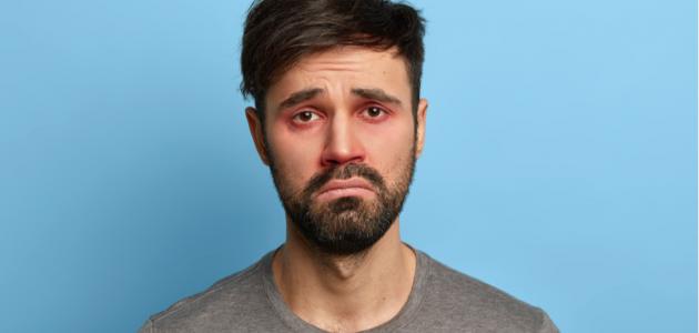 التخلص من تورم العين بعد البكاء