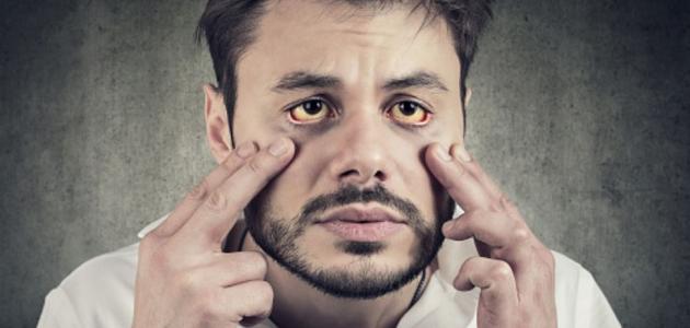 أعراض استئصال المرارة
