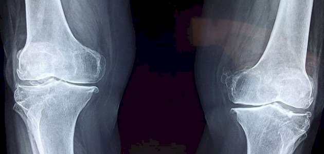 حسب الدراسات: هل يمكن الوقاية من مرض الروماتيزم؟