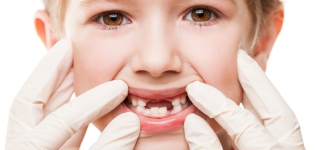 تعرف على علاج الأسنان المتآكلة عند الأطفال