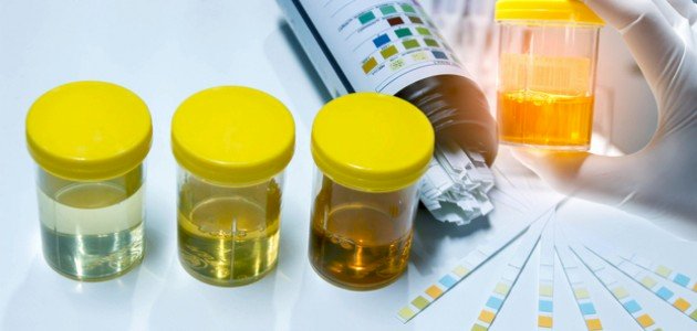 متى تحتاج لعمل مزرعة البول؟