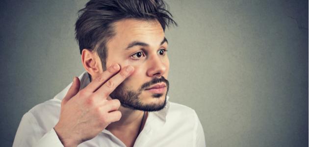 أفضل علاج للانتفاخ تحت العين