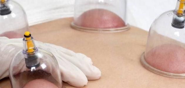 علاج سرعة القذف بالحجامة