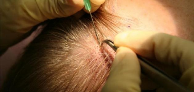 كيف يتم زراعة الشعر