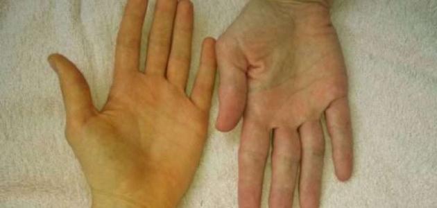 أسباب اصفرار اليدين