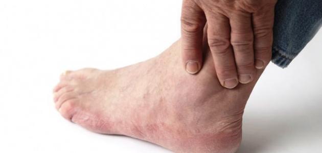 علاج ارتفاع حمض البول