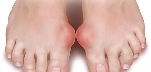 مرض النقرس مرض النقرس