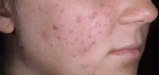 اسباب ظهور حبوب صغيرة في الوجه